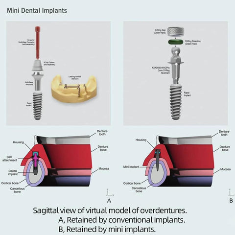 Diagram of mini dental implants showing comparison with conventional implants, including cross-sectional views and components.