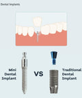 Comparison of mini dental implant and traditional dental implant with diagram of implant in jawbone.